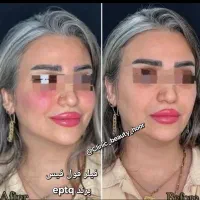 جشنواره تزریق ژل و فیلر بوتاکس کانتورینگ توسط پزشک|خدمات آرایشگری و زیبایی|سنندج, |دیوار