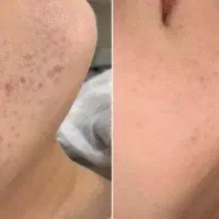 پاکسازی و جوانسازی پوست با تجهیزات پیشرفته|خدمات آرایشگری و زیبایی|رشت, گلسار|دیوار