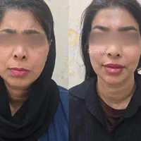 پنجاه درصد تخفیف بوتاکس|خدمات آرایشگری و زیبایی|اهواز, پادادشهر|دیوار