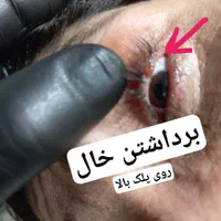 برداشتن خال ، زگیل ، میخچه، جراحی و بوتاکس در مطب|خدمات آرایشگری و زیبایی|تویسرکان, |دیوار
