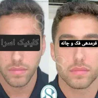 فول فیس ژل لب فیلربیکینی تخفیفات فقط دو روز|خدمات آرایشگری و زیبایی|مشهد, احمدآباد|دیوار