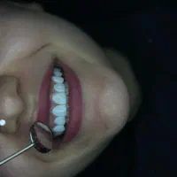 کامپوزیت دندان جشنواره لمینت ایمکس|خدمات آرایشگری و زیبایی|تهران, شمس‌آباد|دیوار