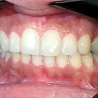 ارتودنسی دو فک فقط با 10میلیون تومان