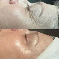 تزریق ژل و بوتاکس|خدمات آرایشگری و زیبایی|هشتگرد, شهرک ولیعصر (مصلی)|دیوار