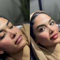 ساکشن چربی و تزریق ژل و بوتاکس و مزو لیفت شقیقه و.|خدمات آرایشگری و زیبایی|کرمانشاه, |دیوار
