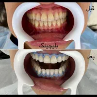 کامپوزیت زیبایی دندان، لمینت، روکش  زیرکونیا|خدمات آرایشگری و زیبایی|کرمانشاه, |دیوار