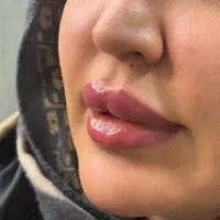 ژل و بوتاکس کلینیک زیبایی دکترفرشیدکریمی|خدمات آرایشگری و زیبایی|کرمانشاه, |دیوار