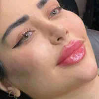 تزریق ژل تا یلدا فقط ۳۵۰