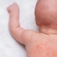 درمان پسوریازیس به صورت ریشه ای|آرایشی، بهداشتی، درمانی|جیرفت, |دیوار