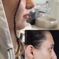 عمل بینی ساکشن غبغب ژل بوتاکس