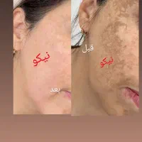 لکه بری صورت تضمینی طی ۱ الی ۳جلسه