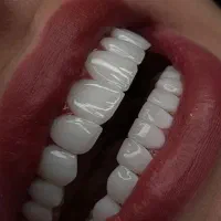 دندانپزشکی تخصصی، ایمپلنت دندان با اقساط بلندمدت