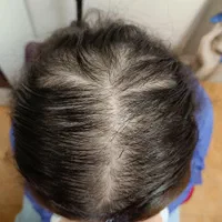 آموزش و خدمات میکرواسکالپ مکمل کاشت مو|خدمات آرایشگری و زیبایی|تهران, الهیه|دیوار