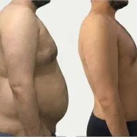 جراحی لیپو‌ساکشن  ابدو مینو پلاستی لیفت سینه
