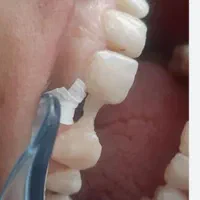 خدمات دندان بریچ frc جایگزین ایمپلنت|خدمات آرایشگری و زیبایی|اهواز, کیانپارس |دیوار