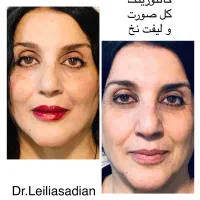 تزریق فیلر (ژل ) لیفت با نخ بوتاکس مزوتراپی|خدمات آرایشگری و زیبایی|مشهد, کوثر|دیوار
