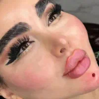 آف فیلر صورت، بوتاکس و پی آر پی تخصصی پزشک