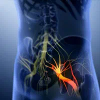 درمان سیاتیک ، زانو درد