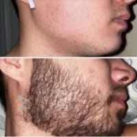 ریش تو پر پشت کن