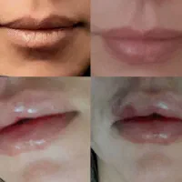 ژل و بوتاکس