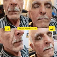 لیفت وجوانسازی با نخ های کاگ و تزریق فیلر ومزوها|خدمات آرایشگری و زیبایی|شیراز, میانرود|دیوار