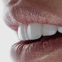 جشنواره کامپوزیت لمینیت عصب کشی روکش imax|خدمات آرایشگری و زیبایی|تهران, اقدسیه|دیوار