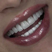 کامپوزیت ونیر اقساطی