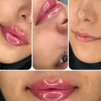 هایفو ،ژل ،بوتاکس، فیلر، مزو جوانساز