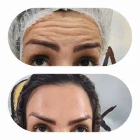 ژل۹۰۰ وبوتاکس۷۰۰مزوژل RF لاغری اموزش لیزر