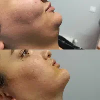 بلفاروپلاستی ،رفع غبغب توسط پزشک زیبایی