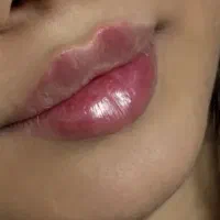 زیبایی چهره هارا ماندگار کن با بوتاکس و فیلر|خدمات آرایشگری و زیبایی|سبزوار, فرهنگیان|دیوار