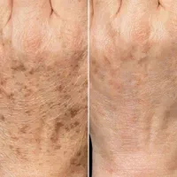 تخفیف ویژه پی آر پی، مزوتراپی، اگزوزوم، گلوتاتیون|خدمات آرایشگری و زیبایی|شیراز, قصرالدشت|دیوار