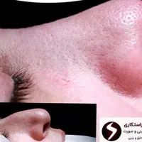 راهنمایی کنید بهترین جراح بینی گوشتی در نیشابور