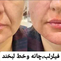 تزریق فیلر و بوتاکس|خدمات آرایشگری و زیبایی|اهواز, گلستان|دیوار