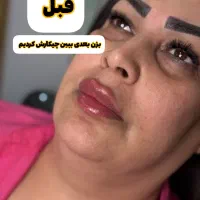 از بین بردن غبغب زیر چونه با یه روش سریع و اقتصادی