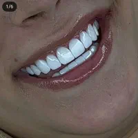 ایمپلنت دندان اقساط ۲۴ ماهه با ۵ شعبه فعال