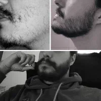 حواست باشه کچل نشی