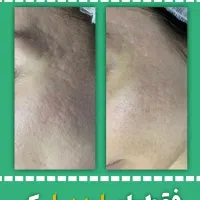 لیزر و رفع رد بخیه و اسکار|خدمات زیبایی و سلامت|مشهد, احمدآباد|دیوار