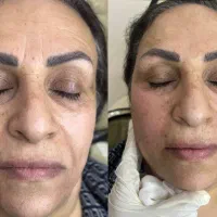 تزریق فیلر و بوتاکس اقساط توسط پزشک در مطب|خدمات آرایشگری و زیبایی|خرمشهر, |دیوار