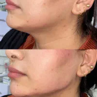ژل بوتاکس ژل لب فیلرزیر چشم مزوتراپی مزوژل|خدمات آرایشگری و زیبایی|شیراز, کاراندیش|دیوار