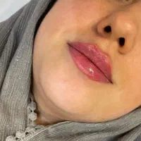 تزریق ژل و بوتاکس
