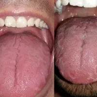 تشخیص بیماری روی زبان