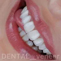 دندانپزشکی کامپوزیت ایمپلنت لمینت  (بدون تراش)|خدمات آرایشگری و زیبایی|تهران, زعفرانیه|دیوار