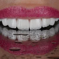 کامپوزیت دندان از دم قسط|خدمات آرایشگری و زیبایی|تهران, بلوار کشاورز|دیوار