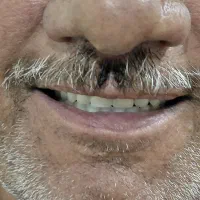 دندان مصنوعی با تخفیفات ویژه به قیمت سال قبل