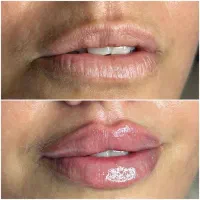 تزریق ژل و بوتاکس|خدمات آرایشگری و زیبایی|هشتگرد, شهرک ولیعصر (مصلی)|دیوار