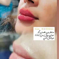 فیلر وبوتاکس|خدمات آرایشگری و زیبایی|گرگان, |دیوار