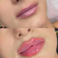 تزریق ژل با ضمانت