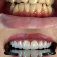 دندان پزشکی امام رضا(روکش تخصصی دندان  3 روزه )