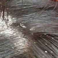 درمان شپش توسط کارشناس حضوری وتخصصی